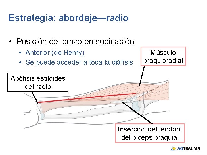 Estrategia: abordaje—radio • Posición del brazo en supinación • Anterior (de Henry) • Se