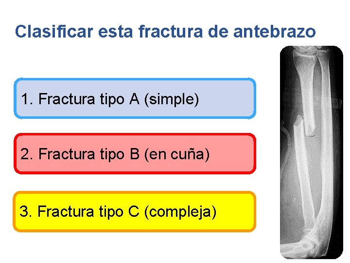 Clasificar esta fractura de antebrazo 1. Fractura tipo A (simple) 2. Fractura tipo B