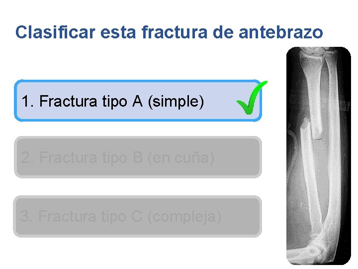 Clasificar esta fractura de antebrazo 1. Fractura tipo A (simple) 2. Fractura tipo B
