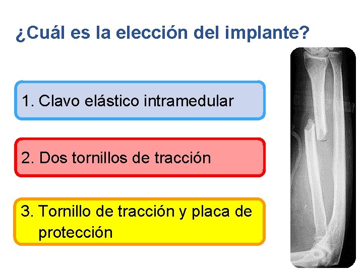 ¿Cuál es la elección del implante? 1. Clavo elástico intramedular 2. Dos tornillos de