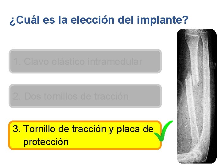 ¿Cuál es la elección del implante? 1. Clavo elástico intramedular 2. Dos tornillos de