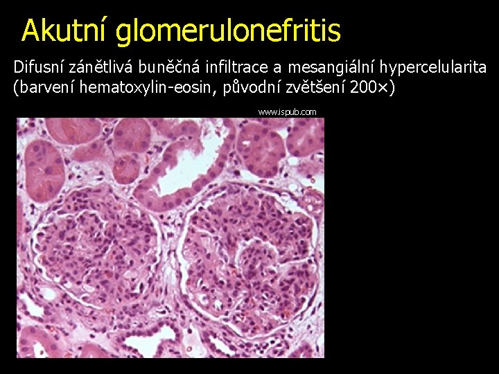 Akutní glomerulonefritis Difusní zánětlivá buněčná infiltrace a mesangiální hypercelularita (barvení hematoxylin-eosin, původní zvětšení 200×)