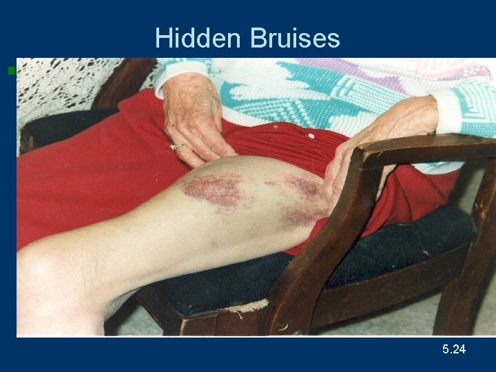 Hidden Bruises 5. 24 