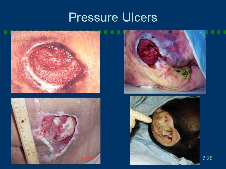 Pressure Ulcers 6. 28 