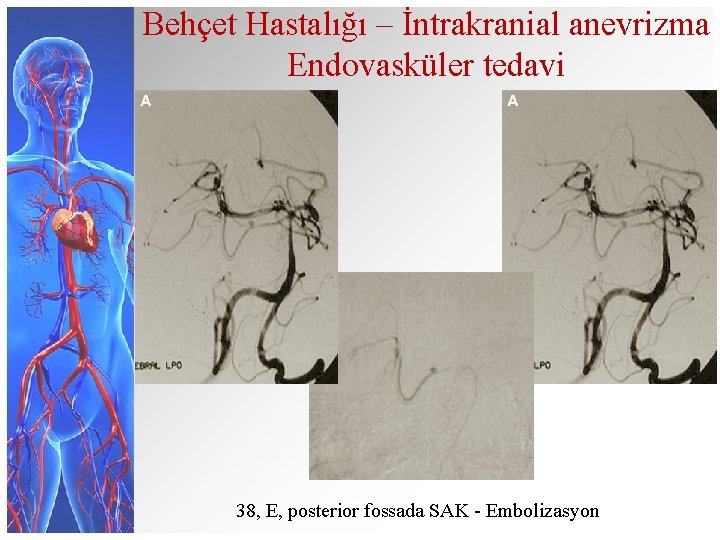 Behçet Hastalığı – İntrakranial anevrizma Endovasküler tedavi 38, E, posterior fossada SAK - Embolizasyon