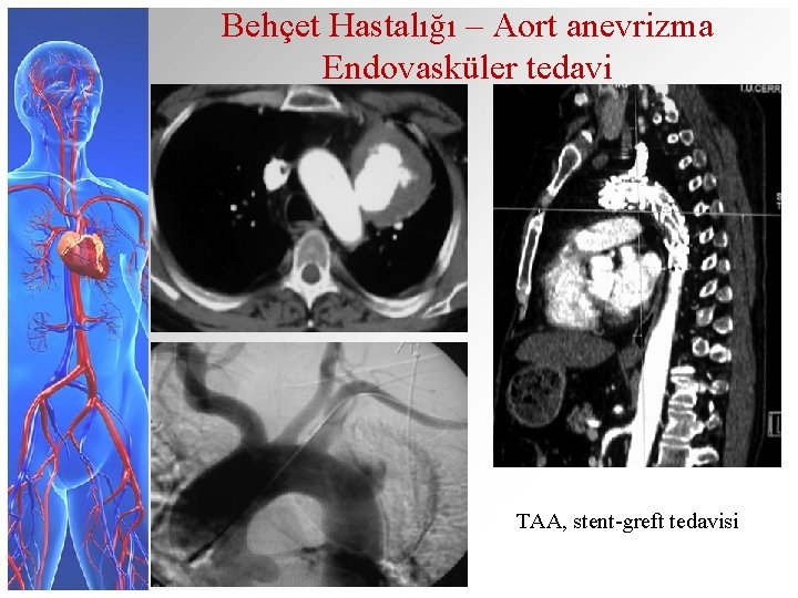 Behçet Hastalığı – Aort anevrizma Endovasküler tedavi TAA, stent-greft tedavisi 