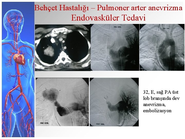 Behçet Hastalığı – Pulmoner arter anevrizma Endovasküler Tedavi 32, E, sağ PA üst lob