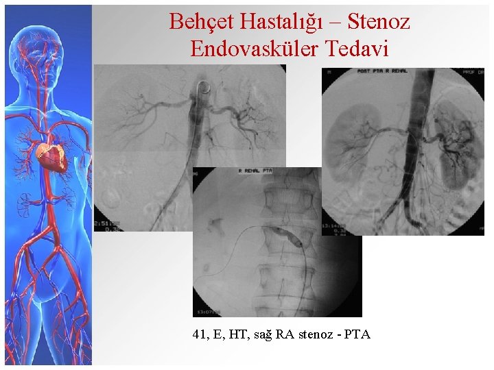 Behçet Hastalığı – Stenoz Endovasküler Tedavi 41, E, HT, sağ RA stenoz - PTA