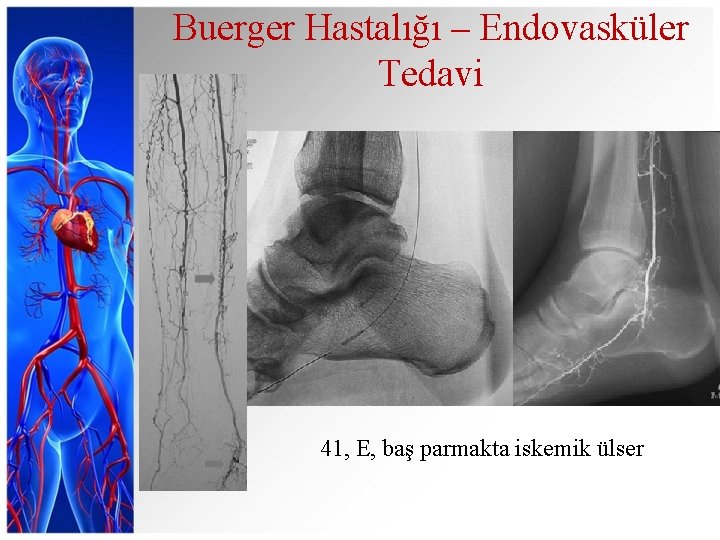 Buerger Hastalığı – Endovasküler Tedavi 41, E, baş parmakta iskemik ülser 