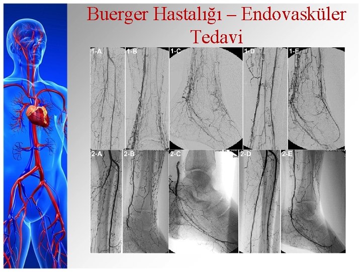 Buerger Hastalığı – Endovasküler Tedavi 