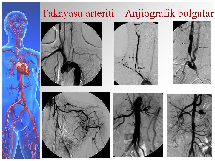 Takayasu arteriti – Anjiografik bulgular 