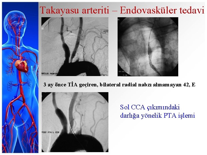 Takayasu arteriti – Endovasküler tedavi 3 ay önce TİA geçiren, bilateral radial nabzı alınamayan