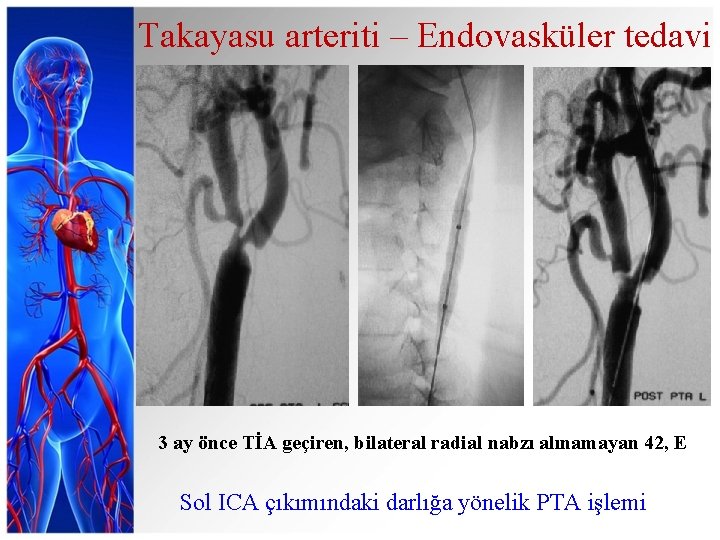 Takayasu arteriti – Endovasküler tedavi 3 ay önce TİA geçiren, bilateral radial nabzı alınamayan