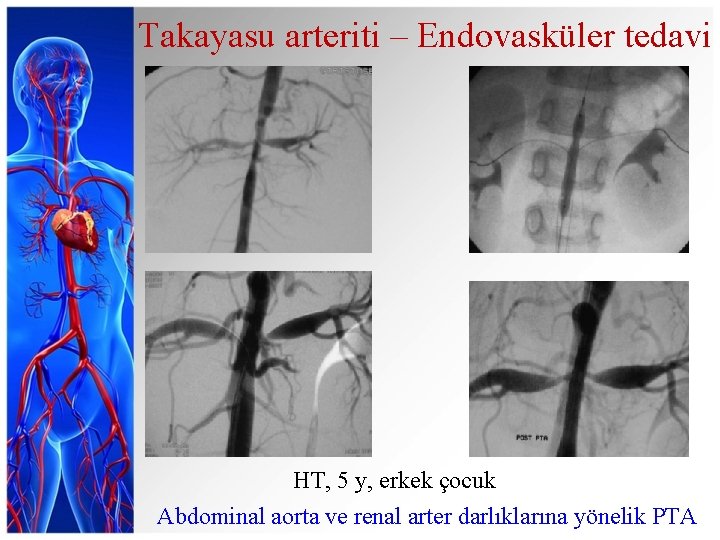 Takayasu arteriti – Endovasküler tedavi HT, 5 y, erkek çocuk Abdominal aorta ve renal