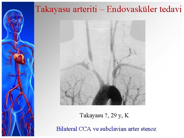 Takayasu arteriti – Endovasküler tedavi Takayasu ? , 29 y, K Bilateral CCA ve