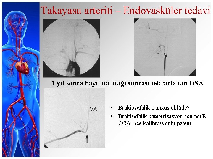 Takayasu arteriti – Endovasküler tedavi 1 yıl sonra bayılma atağı sonrası tekrarlanan DSA •