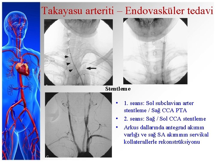 Takayasu arteriti – Endovasküler tedavi Stentleme • 1. seans: Sol subclavian arter stentleme /