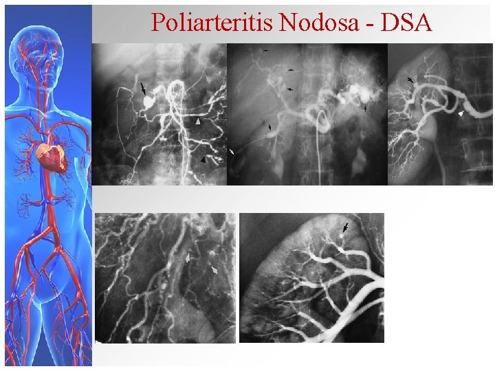 Poliarteritis Nodosa - DSA 