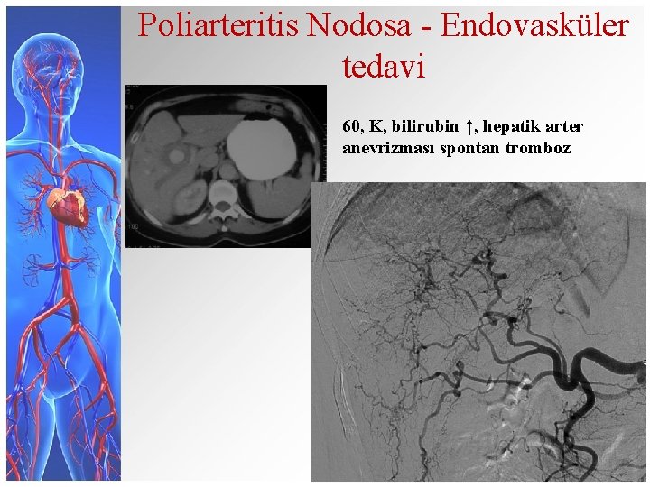 Poliarteritis Nodosa - Endovasküler tedavi 60, K, bilirubin ↑, hepatik arter anevrizması spontan tromboz