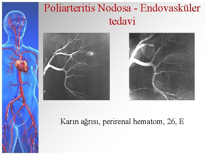 Poliarteritis Nodosa - Endovasküler tedavi Karın ağrısı, perirenal hematom, 26, E 