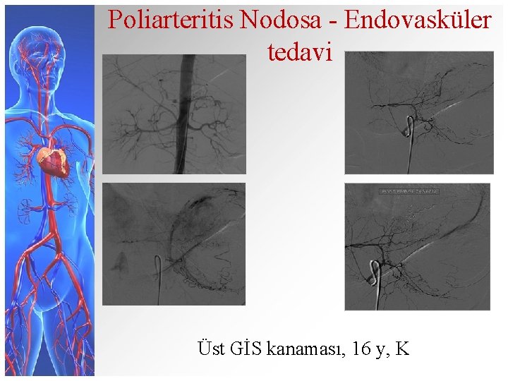 Poliarteritis Nodosa - Endovasküler tedavi Üst GİS kanaması, 16 y, K 