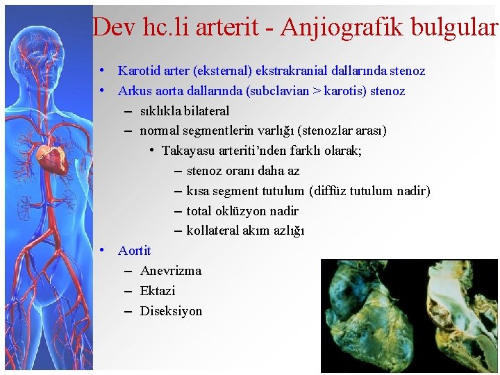 Dev hc. li arterit - Anjiografik bulgular • Karotid arter (eksternal) ekstrakranial dallarında stenoz