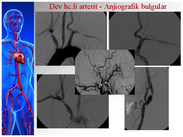 Dev hc. li arterit - Anjiografik bulgular 