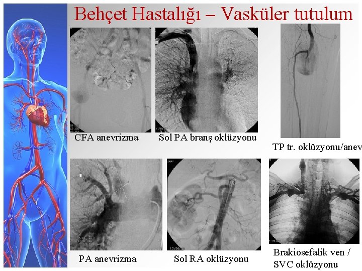 Behçet Hastalığı – Vasküler tutulum CFA anevrizma PA anevrizma Sol PA branş oklüzyonu Sol