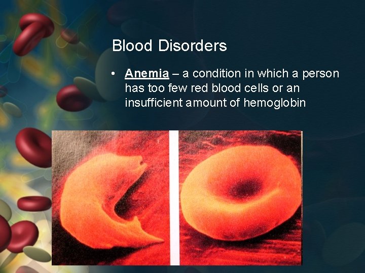 Blood Disorders • Anemia – a condition in which a person has too few