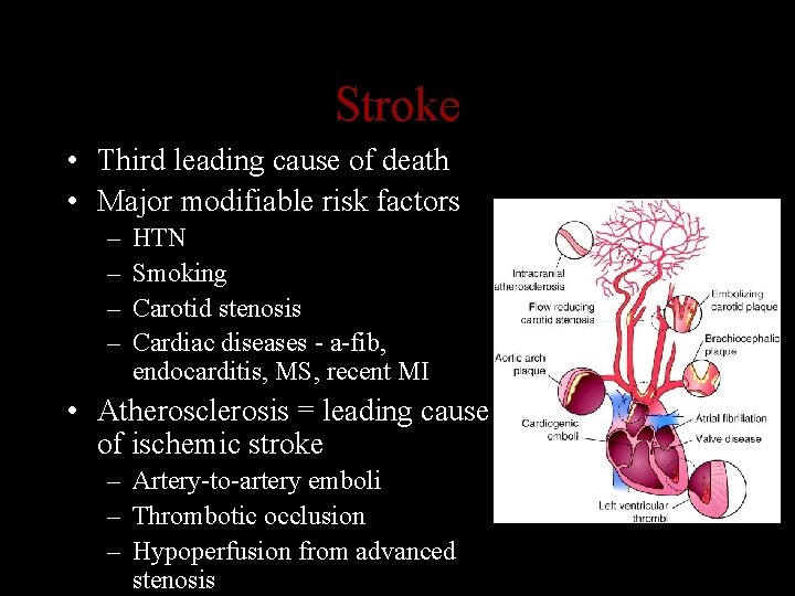 Stroke • Third leading cause of death • Major modifiable risk factors – –