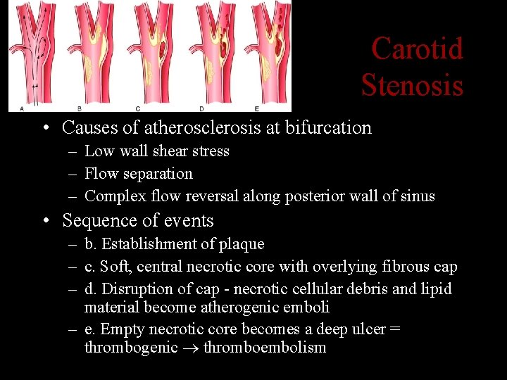 Carotid Stenosis • Causes of atherosclerosis at bifurcation – Low wall shear stress –