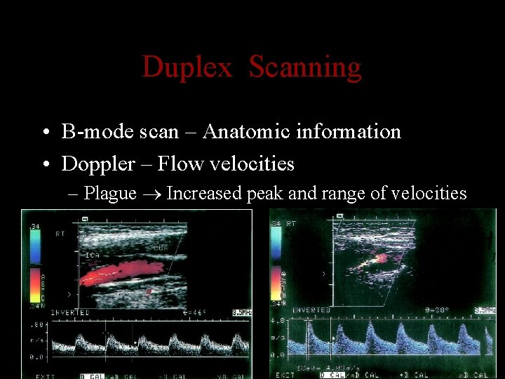 Duplex Scanning • B-mode scan – Anatomic information • Doppler – Flow velocities –