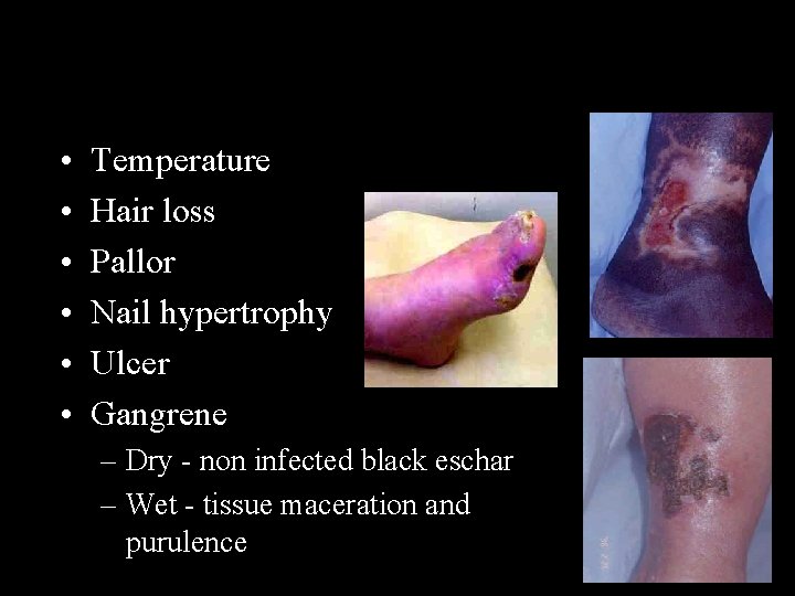  • • • Temperature Hair loss Pallor Nail hypertrophy Ulcer Gangrene – Dry