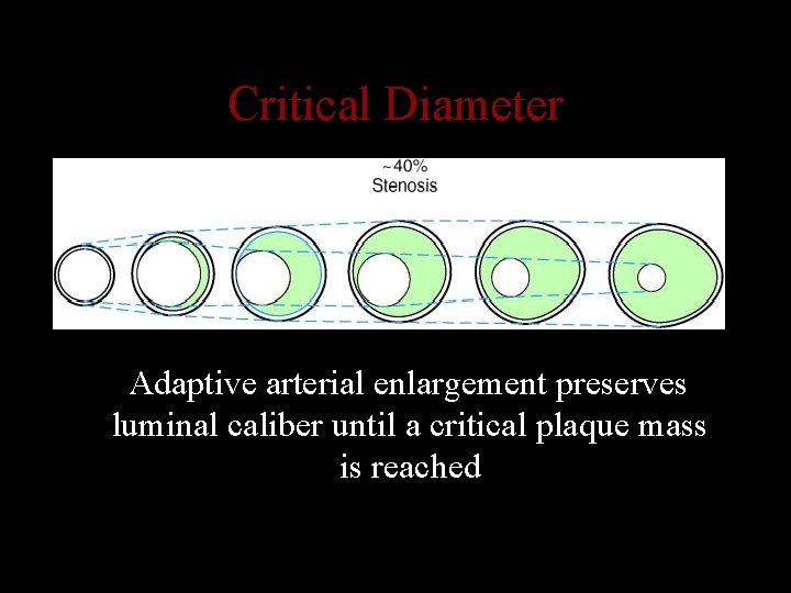 Critical Diameter Adaptive arterial enlargement preserves luminal caliber until a critical plaque mass is