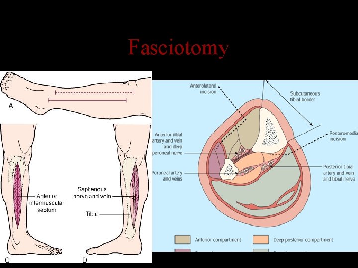 Fasciotomy 