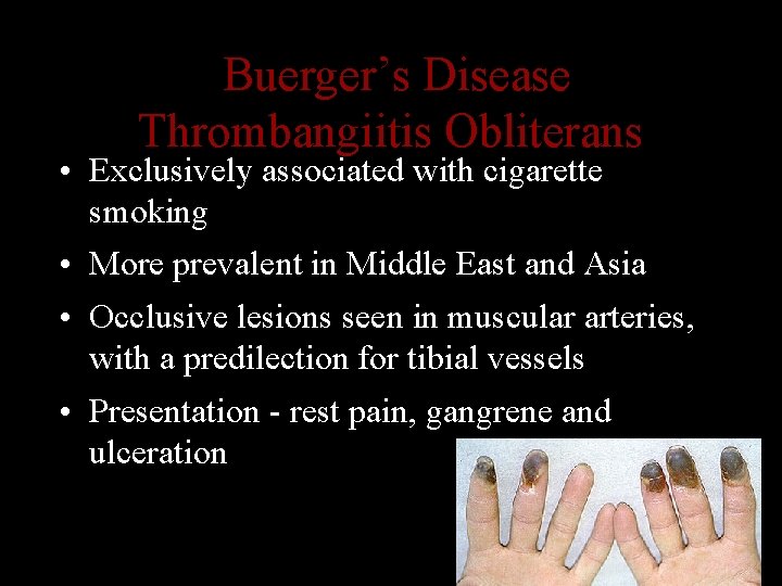 Buerger’s Disease Thrombangiitis Obliterans • Exclusively associated with cigarette smoking • More prevalent in