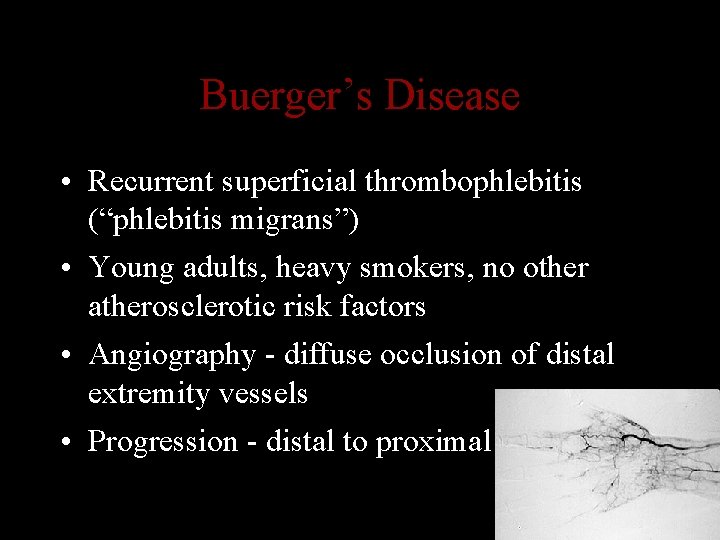 Buerger’s Disease • Recurrent superficial thrombophlebitis (“phlebitis migrans”) • Young adults, heavy smokers, no