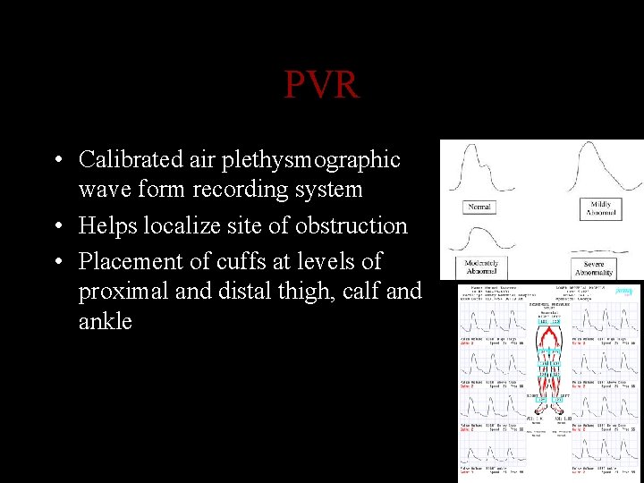 PVR • Calibrated air plethysmographic wave form recording system • Helps localize site of