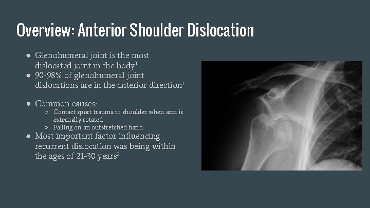 Overview: Anterior Shoulder Dislocation ● Glenohumeral joint is the most dislocated joint in the