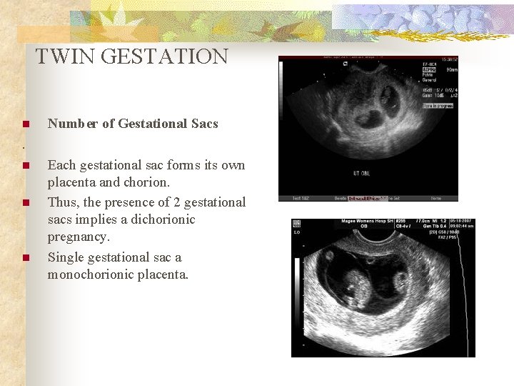 TWIN GESTATION n Number of Gestational Sacs . n n n Each gestational sac