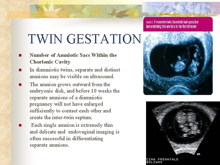 TWIN GESTATION n n Number of Amniotic Sacs Within the Chorionic Cavity In diamniotic