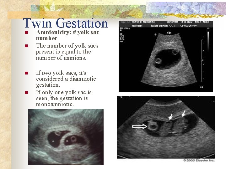 Twin Gestation Amnionicity: # yolk sac n n number The number of yolk sacs