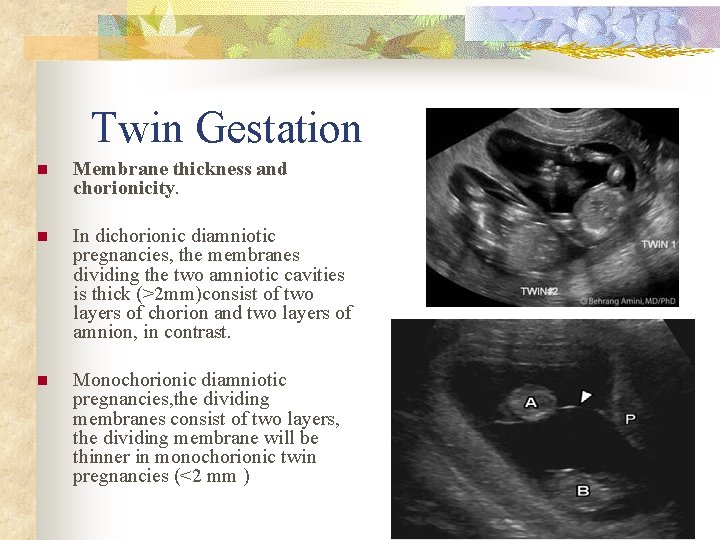 Twin Gestation n Membrane thickness and chorionicity. n In dichorionic diamniotic pregnancies, the membranes