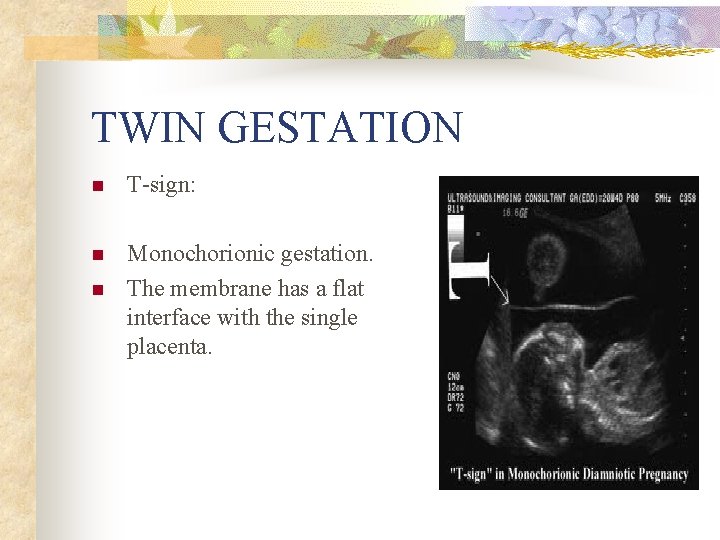 TWIN GESTATION n T sign: n Monochorionic gestation. The membrane has a flat interface