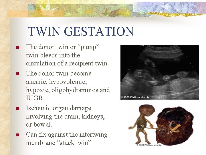TWIN GESTATION n n The donor twin or “pump” twin bleeds into the circulation