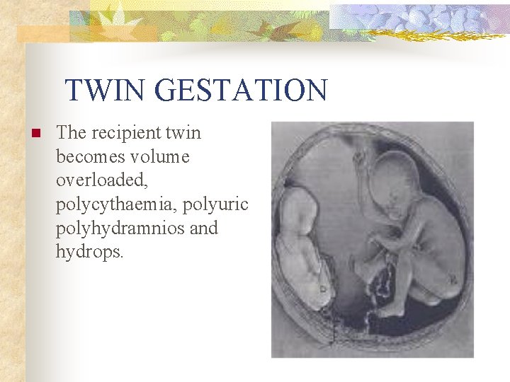 TWIN GESTATION n The recipient twin becomes volume overloaded, polycythaemia, polyuric polyhydramnios and hydrops.
