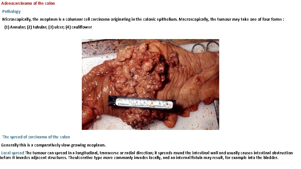 Adenocarcinoma of the colon Pathology Microscopically, the neoplasm is a columnar cell carcinoma originating