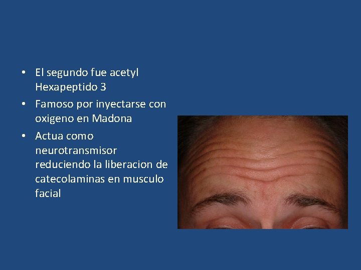  • El segundo fue acetyl Hexapeptido 3 • Famoso por inyectarse con oxigeno
