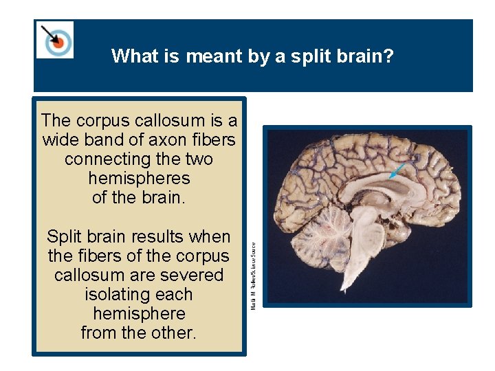 What is meant by a split brain? The corpus callosum is a wide band