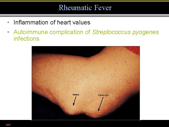 Rheumatic Fever • Inflammation of heart values • Autoimmune complication of Streptococcus pyogenes infections